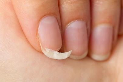 Kırılgan tırnaklar bu 3 hastalığın habercisi: Vücudunuzda eksik olabilir