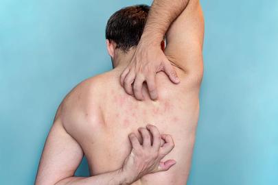 İngiltere'de uyuz vakaları neden artıyor?